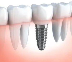 Dental Implants Dentist Wilmslow Announces Appointment Availability for New Patients at The Croft Dental & Implant Practice